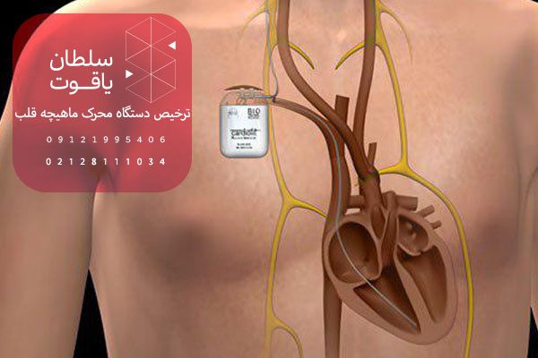 ترخیص دستگاه‌های محرک ماهیچه قلب از گمرک